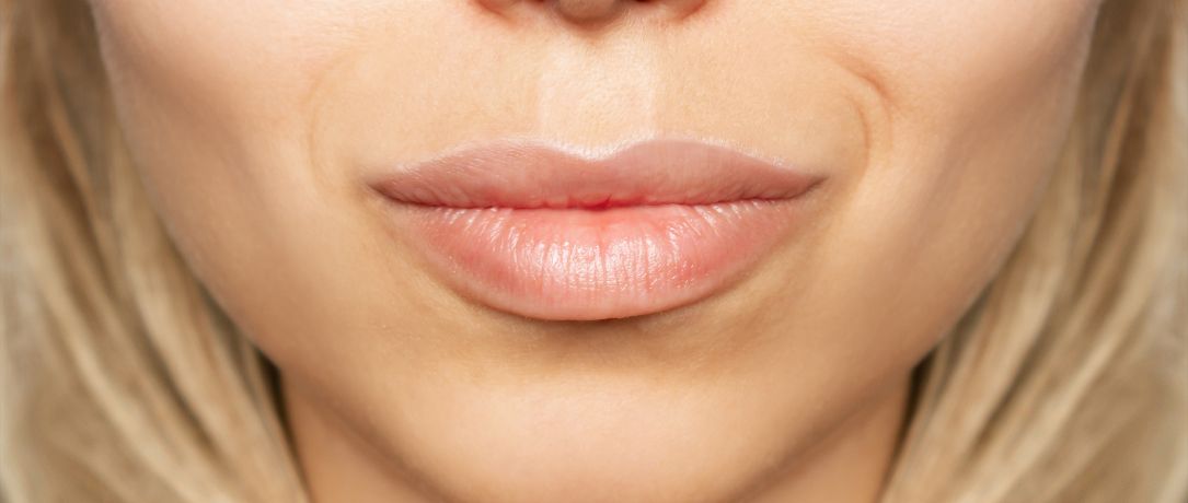 Filler labbra: i segreti dell'acido ialuronico